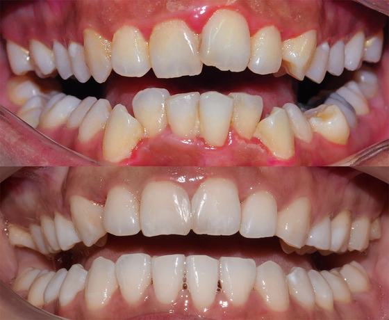 Before and after smile transformation at Dr MeiLuk by L&M Dental Clinic 1