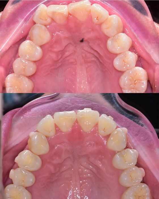 Before and after smile transformation at Dr MeiLuk by L&M Dental Clinic 2