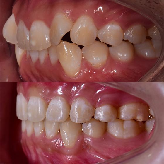 Before and after smile transformation at Dr MeiLuk by L&M Dental Clinic 3