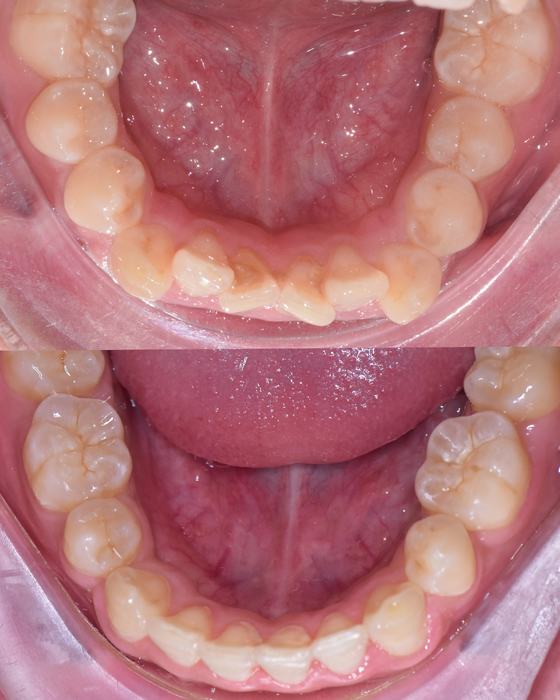Before and after smile transformation at Dr MeiLuk by L&M Dental Clinic 4