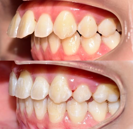 Before and after smile transformation at Dr MeiLuk by L&M Dental Clinic 5