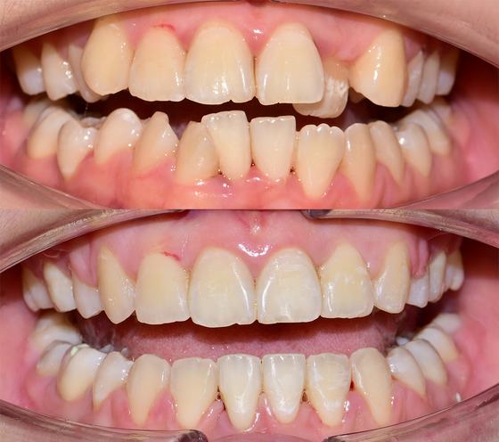Before and after smile transformation at Dr MeiLuk by L&M Dental Clinic 6