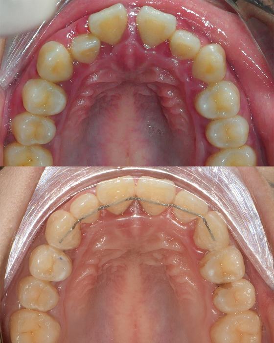Before and after smile transformation at Dr MeiLuk by L&M Dental Clinic 7