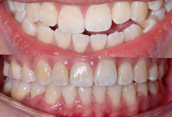 Before and after smile transformation at Dr MeiLuk by L&M Dental Clinic 8