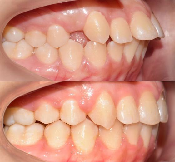 Before and after smile transformation at Dr MeiLuk by L&M Dental Clinic 9
