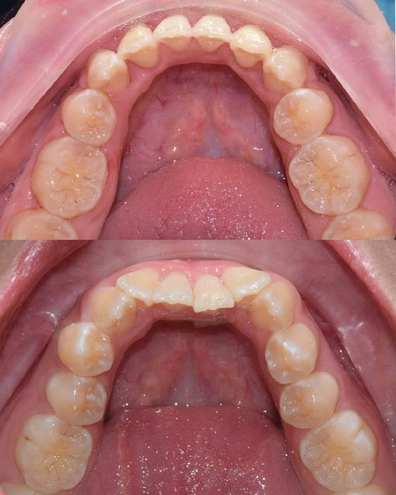 Before and after smile transformation at Dr MeiLuk by L&M Dental Clinic 10