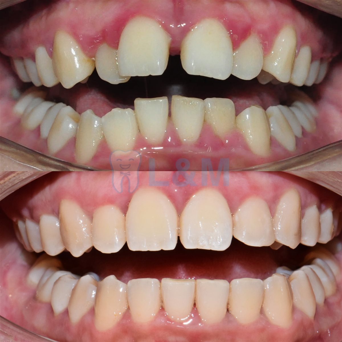Real patient before and after braces result, Dr MeiLuk by L&M Dental Clinic
