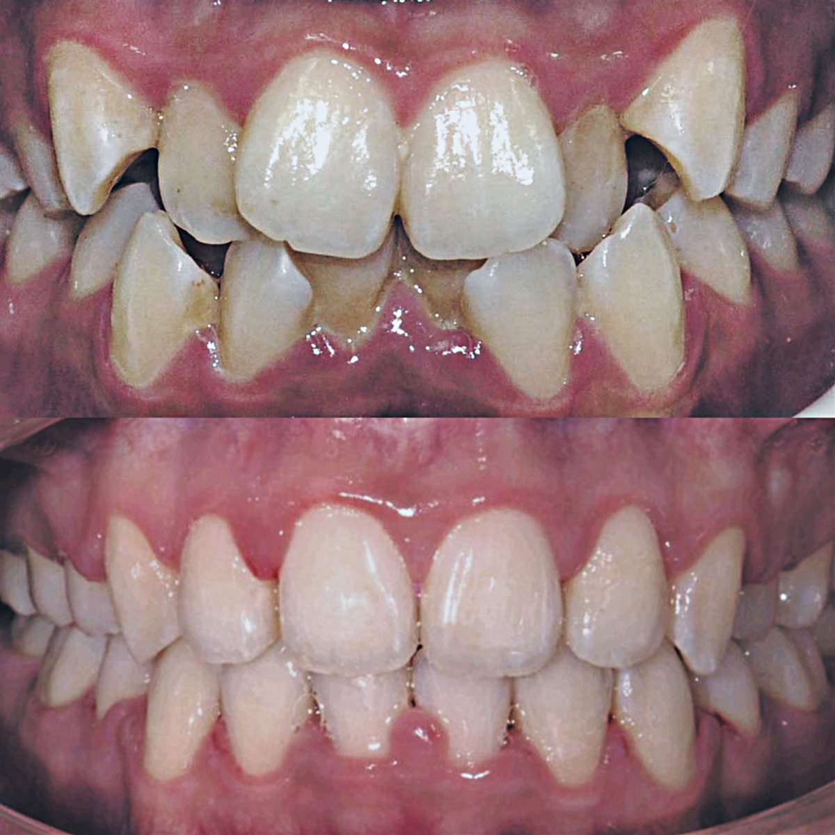 Real patient before and after braces result, Dr MeiLuk by L&M Dental Clinic